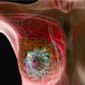 Triệu chứng và dấu hiệu ung thư vú